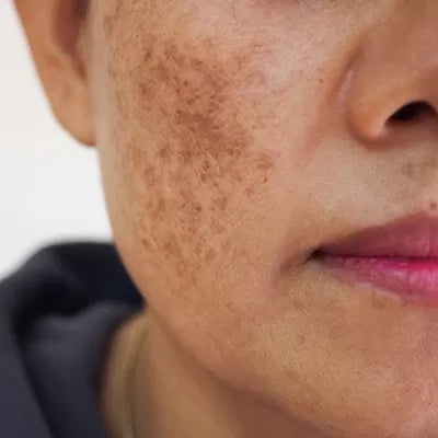 pigmentation