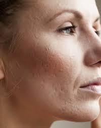 uneven skin tone